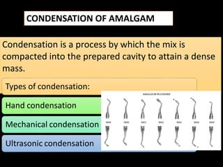 dental material science dental amalgamgam | PDF