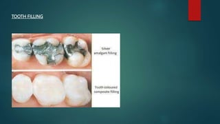 TOOTH FILLING
 