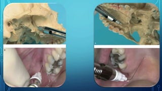 Dental Anesthesia Dental Anaesthesia Techniques & Complications