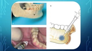 Dental Anesthesia Dental Anaesthesia Techniques & Complications