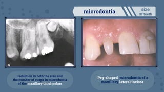 Microindentation Tooth Dental anomalies | PDF