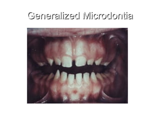 Micro Tooth Dental Anomalies oral pathology oral.ppt