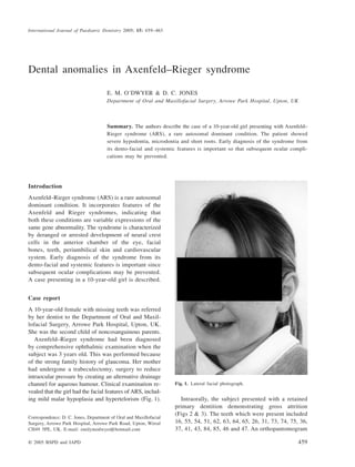 International Journal of Paediatric Dentistry 2005; 15: 459–463
© 2005 BSPD and IAPD 459
Blackwell Publishing, Ltd.
Dental anomalies in Axenfeld–Rieger syndrome
E. M. O’DWYER & D. C. JONES
Department of Oral and Maxillofacial Surgery, Arrowe Park Hospital, Upton, UK
Summary. The authors describe the case of a 10-year-old girl presenting with Axenfeld–
Rieger syndrome (ARS), a rare autosomal dominant condition. The patient showed
severe hypodontia, microdontia and short roots. Early diagnosis of the syndrome from
its dento-facial and systemic features is important so that subsequent ocular compli-
cations may be prevented.
Introduction
Axenfeld–Rieger syndrome (ARS) is a rare autosomal
dominant condition. It incorporates features of the
Axenfeld and Rieger syndromes, indicating that
both these conditions are variable expressions of the
same gene abnormality. The syndrome is characterized
by deranged or arrested development of neural crest
cells in the anterior chamber of the eye, facial
bones, teeth, periumbilical skin and cardiovascular
system. Early diagnosis of the syndrome from its
dento-facial and systemic features is important since
subsequent ocular complications may be prevented.
A case presenting in a 10-year-old girl is described.
Case report
A 10-year-old female with missing teeth was referred
by her dentist to the Department of Oral and Maxil-
lofacial Surgery, Arrowe Park Hospital, Upton, UK.
She was the second child of noncosanguinous parents.
Axenfeld–Rieger syndrome had been diagnosed
by comprehensive ophthalmic examination when the
subject was 3 years old. This was performed because
of the strong family history of glaucoma. Her mother
had undergone a trabeculectomy, surgery to reduce
intraocular pressure by creating an alternative drainage
channel for aqueous humour. Clinical examination re-
vealed that the girl had the facial features of ARS, includ-
ing mild malar hypoplasia and hypertelorism (Fig. 1). Intraorally, the subject presented with a retained
primary dentition demonstrating gross attrition
(Figs 2 & 3). The teeth which were present included
16, 55, 54, 51, 62, 63, 64, 65, 26, 31, 73, 74, 75, 36,
37, 41, 43, 84, 85, 46 and 47. An orthopantomogram
Correspondence: D. C. Jones, Department of Oral and Maxillofacial
Surgery, Arrowe Park Hospital, Arrowe Park Road, Upton, Wirral
CH49 5PE, UK. E-mail: emilymodwyer@hotmail.com
Fig. 1. Lateral facial photograph.
 