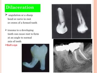 Dental anomaly | PPT