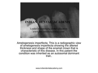 Amelogenesis imperfecta. This is a radiographic view
of amelogenesis imperfecta showing the altered
thickness and shape of the enamel crown that is
characteristic of this disease. In this patient the
condition was inherited as an autosomal dominant
trait..
INDIAN DENTAL ACADEMY
Leader in continuing dental education
www.indiandentalacademy.com
www.indiandentalacademy.com
 