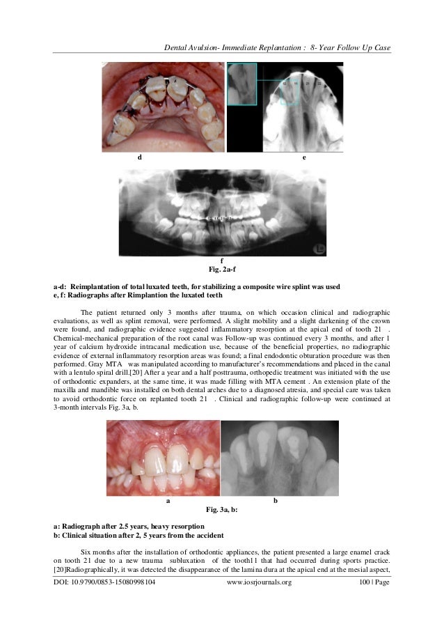 Dental avulsion immediate replantation