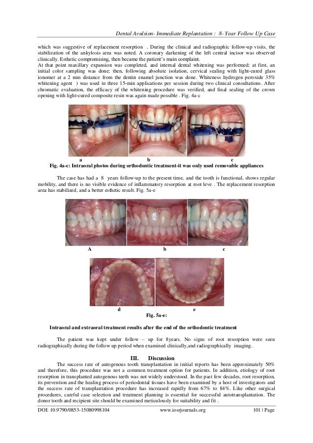Dental avulsion immediate replantation