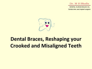 Dental Braces, Reshaping your 
Crooked and Misaligned Teeth 
 