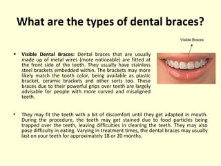 What are the types of dental braces? 
• Visible Dental Braces: Dental braces that are usually 
made up of metal wires (more noticeable) are fitted at 
the front side of the teeth. They usually have stainless 
steel brackets embedded within. The brackets may more 
likely match the tooth color, being available as plastic 
bracket, ceramic brackets and other sorts too. These 
braces due to their powerful grips over teeth are largely 
advisable for people with more curved and misaligned 
teeth. 
Visible Braces 
• They may fit the teeth with a bit of discomfort until they get adapted in mouth. 
During the procedure, the teeth may get stained due to food particles being 
trapped over the teeth, leaving difficulties in cleaning the teeth. They may also 
pose difficulty in eating. Varying in treatment times, the dental braces may usually 
last on your teeth for approximately 18 or 20 months. 
 