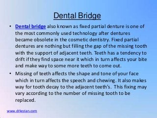 Dental Bridge
 • Dental bridge also known as fixed partial denture is one of
   the most commonly used technology after dentures
   became obsolete in the cosmetic dentistry. Fixed partial
   dentures are nothing but filling the gap of the missing tooth
   with the support of adjacent teeth. Teeth has a tendency to
   drift if they find space near it which in turn affects your bite
   and make way to some more teeth to come out.
 • Missing of teeth affects the shape and tone of your face
   which in turn affects the speech and chewing. It also makes
   way for tooth decay to the adjacent teeth’s. This fixing may
   vary according to the number of missing tooth to be
   replaced.
www.drkezian.com
 