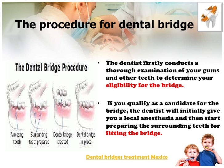 Dental bridges treatment in Mexico,Cancun & Tijuana from ...