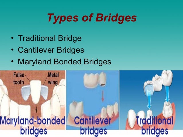 cantilever bridge dental