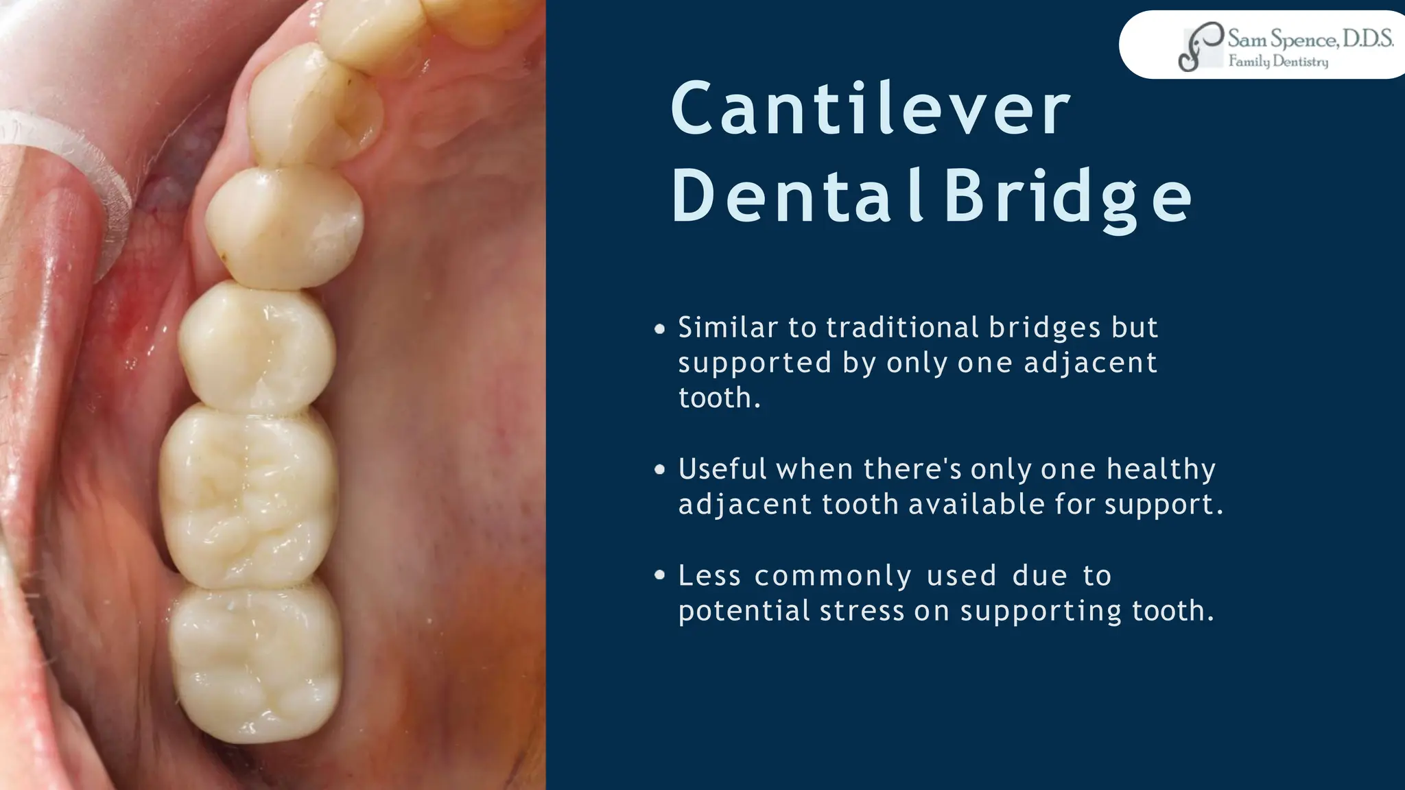 Cantilever
Denta l Bridg e
Similar to traditional bridges but
supported by only one adjacent
tooth.
Useful when there's only one healthy
adjacent tooth available for support.
Less commonly used due to
potential stress on supporting tooth.
 