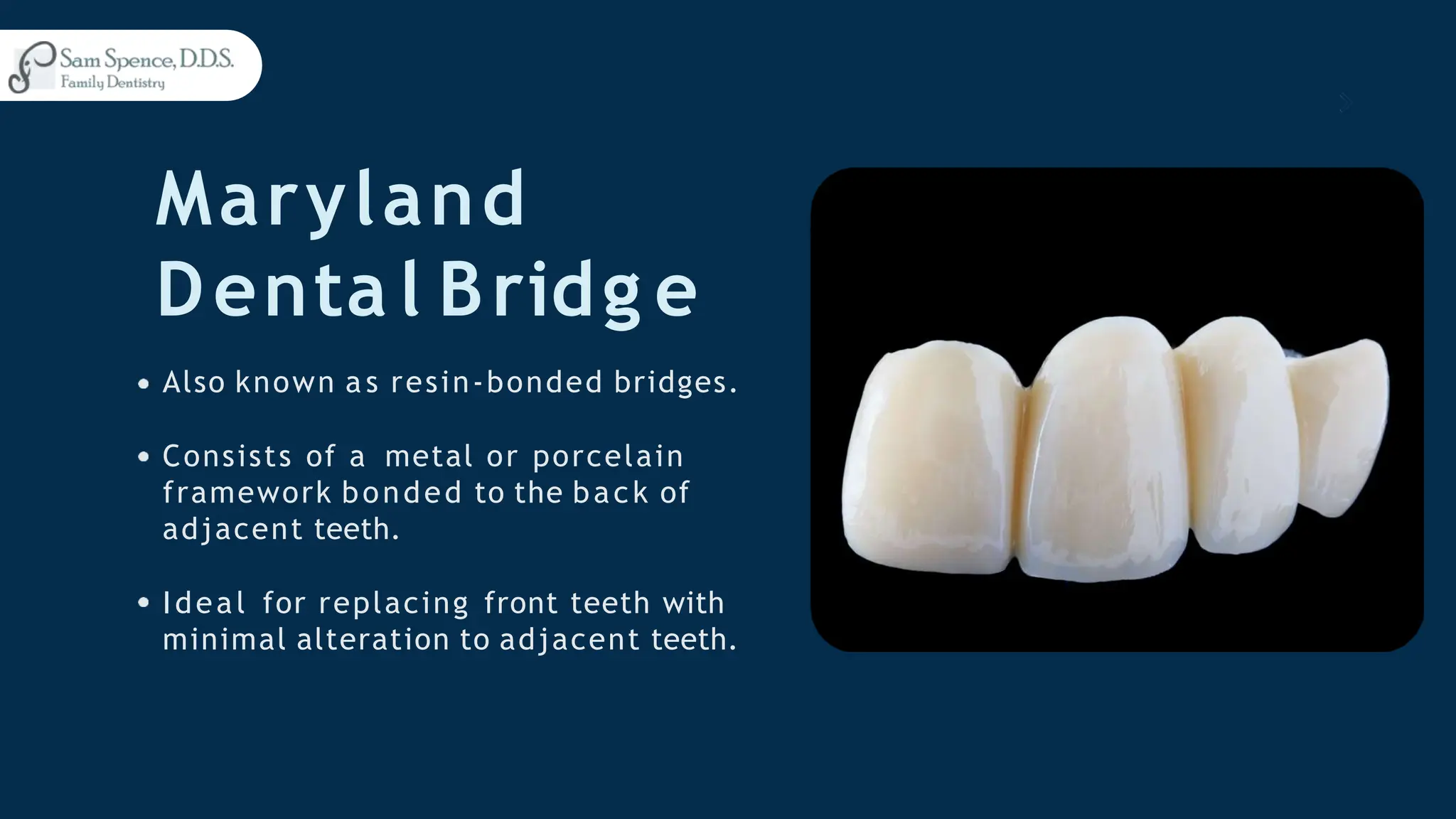 Maryland
Denta l Bridg e
Also known a s resin-bonded bridges.
Consists of a metal or porcelain
framework bonded to the back of
adjacent teeth.
Ideal for replacing front teeth with
minimal alteration to adjacent teeth.
 