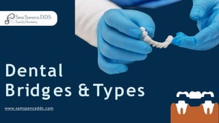 Dental
Bridg es & Types
www.samspencedds.com
 