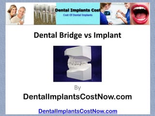 Dental Bridge vs Implant




              By
DentalImplantsCostNow.com
   DentalImplantsCostNow.com
 