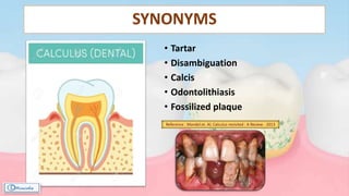 SYNONYMS
• Tartar
• Disambiguation
• Calcis
• Odontolithiasis
• Fossilized plaque
Reference : Mandel et. Al; Calculus revisited : A Review - 2013
 