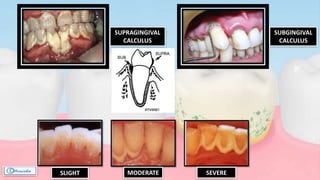 SUPRAGINGIVAL
CALCULUS
SLIGHT MODERATE SEVERE
SUBGINGIVAL
CALCULUS
 