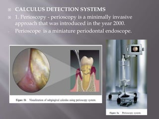  CALCULUS DETECTION SYSTEMS
 1. Perioscopy - perioscopy is a minimally invasive
approach that was introduced in the year 2000.
- Perioscope is a miniature periodontal endoscope.
 