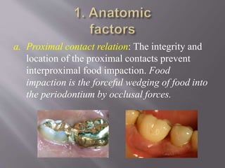 a. Proximal contact relation: The integrity and
location of the proximal contacts prevent
interproximal food impaction. Food
impaction is the forceful wedging of food into
the periodontium by occlusal forces.
 