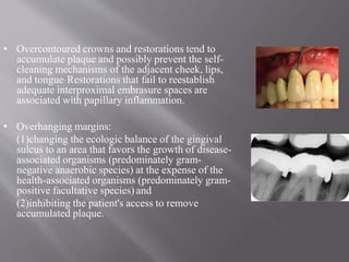 • Overcontoured crowns and restorations tend to
accumulate plaque and possibly prevent the self-
cleaning mechanisms of the adjacent cheek, lips,
and tongue. Restorations that fail to reestablish
adequate interproximal embrasure spaces are
associated with papillary inflammation.
• Overhanging margins:
(1)changing the ecologic balance of the gingival
sulcus to an area that favors the growth of disease-
associated organisms (predominately gram-
negative anaerobic species) at the expense of the
health-associated organisms (predominately gram-
positive facultative species) and
(2)inhibiting the patient's access to remove
accumulated plaque.
 