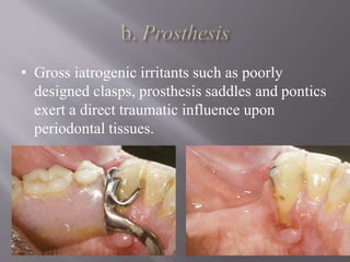 • Gross iatrogenic irritants such as poorly
designed clasps, prosthesis saddles and pontics
exert a direct traumatic influence upon
periodontal tissues.
 