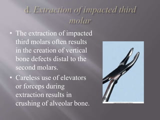 • The extraction of impacted
third molars often results
in the creation of vertical
bone defects distal to the
second molars.
• Careless use of elevators
or forceps during
extraction results in
crushing of alveolar bone.
 
