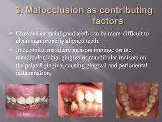 • Crowded or malaligned teeth can be more difficult to
clean than properly aligned teeth.
• In deepbite, maxillary incisors impinge on the
mandibular labial gingiva or mandibular incisors on
the palatal gingiva, causing gingival and periodontal
inflammation.
 