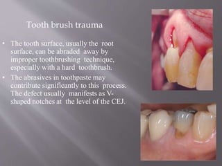 • The tooth surface, usually the root
surface, can be abraded away by
improper toothbrushing technique,
especially with a hard toothbrush.
• The abrasives in toothpaste may
contribute significantly to this process.
The defect usually manifests as V-
shaped notches at the level of the CEJ.
Tooth brush trauma
 