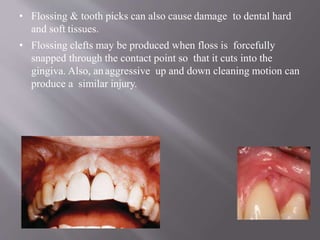 • Flossing & tooth picks can also cause damage to dental hard
and soft tissues.
• Flossing clefts may be produced when floss is forcefully
snapped through the contact point so that it cuts into the
gingiva. Also, anaggressive up and down cleaning motion can
produce a similar injury.
 