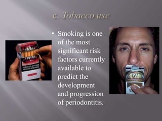 • Smoking is one
of the most
significant risk
factors currently
available to
predict the
development
and progression
of periodontitis.
 