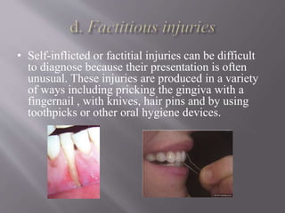 • Self-inflicted or factitial injuries can be difficult
to diagnose because their presentation is often
unusual. These injuries are produced in a variety
of ways including pricking the gingiva with a
fingernail , with knives, hair pins and by using
toothpicks or other oral hygiene devices.
 