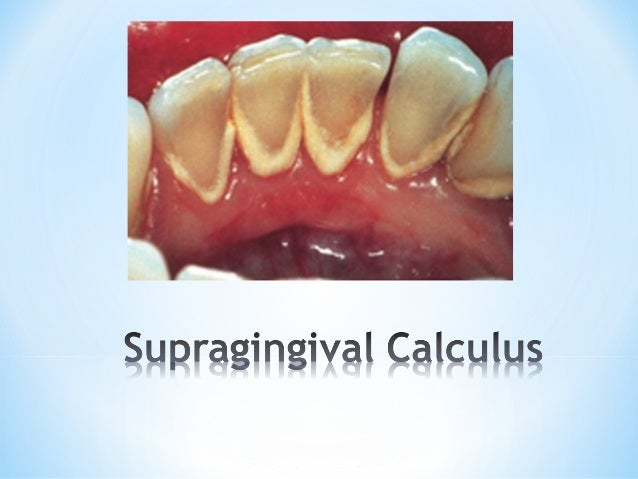 calculus teeth
