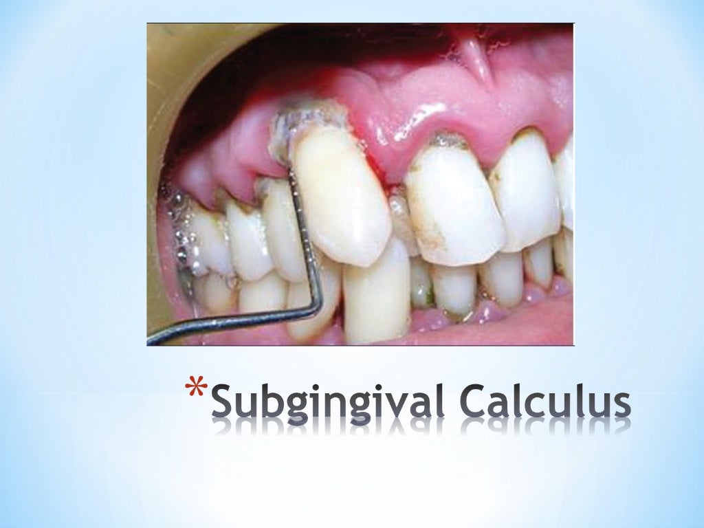 Dental Calculus