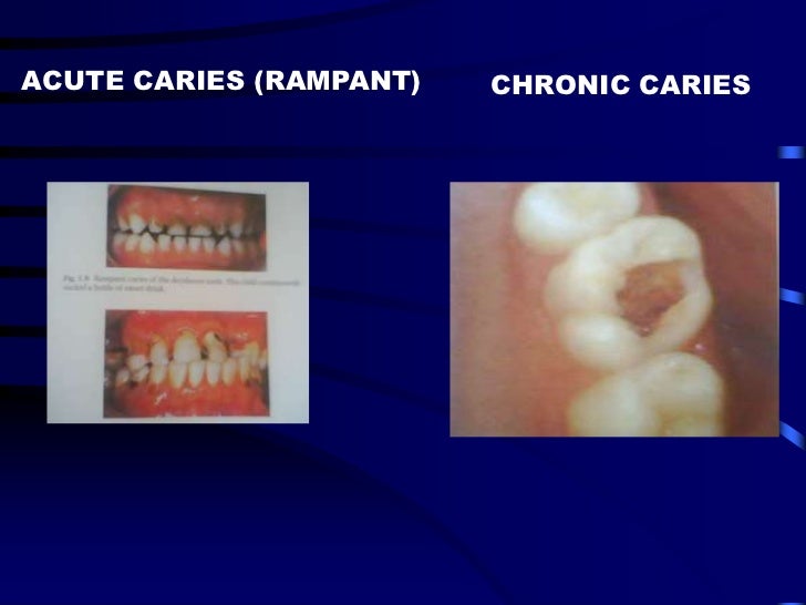 Dental caries