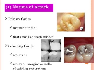 (O1l)d N Tahtueoreri oefs Attack 
 Primary Caries 
 incipient; initial 
 first attack on tooth surface 
 Secondary Caries 
 recurrent 
 occurs on margins or walls 
of existing restorations 
 
