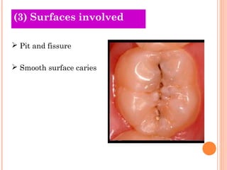 (O3l)d S Tuhrfeaocreies si nvolved 
 Pit and fissure 
 Smooth surface caries 
 