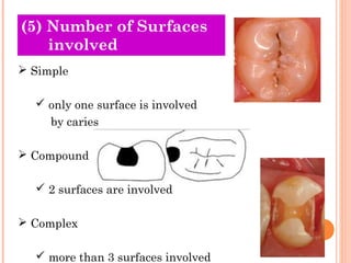 (O5l)d N Tuhmeobreire os f Surfaces 
involved 
 Simple 
 only one surface is involved 
by caries 
 Compound 
 2 surfaces are involved 
 Complex 
 more than 3 surfaces involved 
 