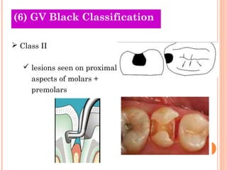 (O6l)d G TVh Beolariceks Classification 
 Class II 
 lesions seen on proximal 
aspects of molars + 
premolars 
 