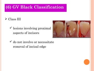 (O6l)d G TVh Beolariceks Classification 
 Class III 
 lesions involving proximal 
aspects of incisors 
 do not involve or necessitate 
removal of incisal edge 
 