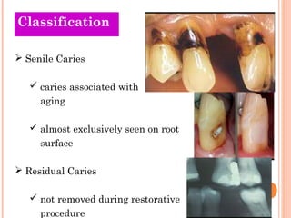 Classification 
 Senile Caries 
 caries associated with 
aging 
 almost exclusively seen on root 
surface 
 Residual Caries 
 not removed during restorative 
procedure 
 