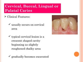 Cervical, Buccal, Lingual or 
Palatal Caries 
 Clinical Features: 
 usually occurs on cervical 
area 
 typical cervical lesion is a 
crescent shaped cavity 
beginning as slightly 
roughened chalky area 
 gradually becomes excavated 
 
