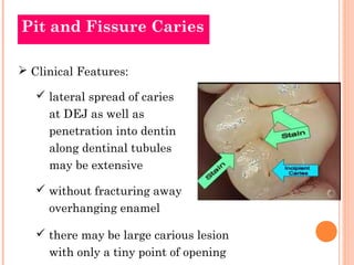 Pit and Fissure Caries 
 Clinical Features: 
 lateral spread of caries 
at DEJ as well as 
penetration into dentin 
along dentinal tubules 
may be extensive 
 without fracturing away 
overhanging enamel 
 there may be large carious lesion 
with only a tiny point of opening 
 