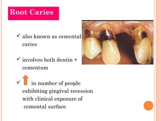 Root Caries 
 also known as cemental 
caries 
 involves both dentin + 
cementum 
 in number of people 
exhibiting gingival recession 
with clinical exposure of 
cemental surface 
 