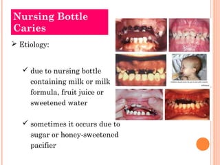 Nursing Bottle 
Caries 
 Etiology: 
 due to nursing bottle 
containing milk or milk 
formula, fruit juice or 
sweetened water 
 sometimes it occurs due to 
sugar or honey-sweetened 
pacifier 
 