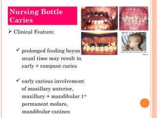 Nursing Bottle 
Caries 
 Clinical Feature: 
 prolonged feeding beyond 
usual time may result in 
early + rampant caries 
 early carious involvement 
of maxillary anterior, 
maxillary + mandibular 1st 
permanent molars, 
mandibular canines 
 
