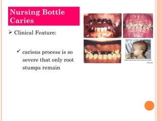 Nursing Bottle 
Caries 
 Clinical Feature: 
 carious process is so 
severe that only root 
stumps remain 
 