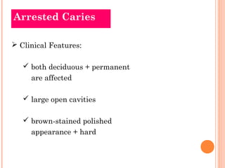 Arrested Caries 
 Clinical Features: 
 both deciduous + permanent 
are affected 
 large open cavities 
 brown-stained polished 
appearance + hard 
 