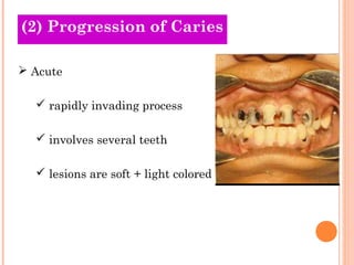 (2) Progression of Caries
Old Theories

 Acute

   rapidly invading process

   involves several teeth

   lesions are soft + light colored
 