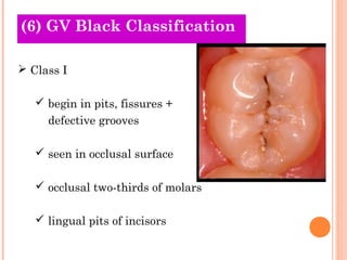 (6) GV Black
Old Theories Classification

 Class I

    begin in pits, fissures +
     defective grooves

    seen in occlusal surface

    occlusal two-thirds of molars

    lingual pits of incisors
 